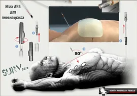 Декомпрессионная игла для пневмоторакса ARS Needle Decompression Kit