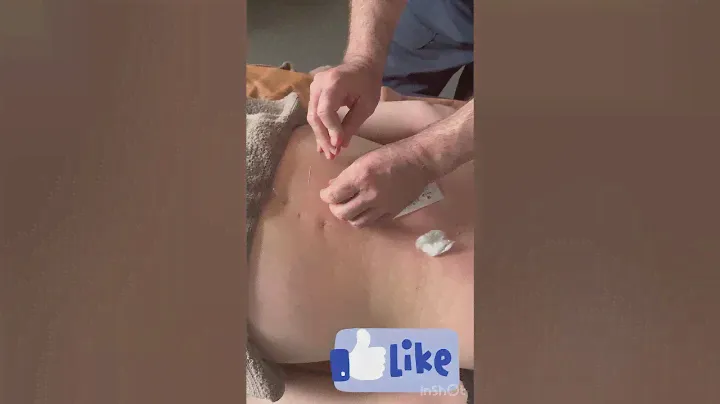 Акупунктурные иглы. Методика установки